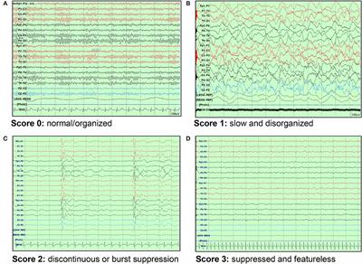 Combination of Early EEG, Brain CT, and Ammonia Level Is Useful to Predict Neurologic Outcome in Children Resuscitated From Cardiac Arrest